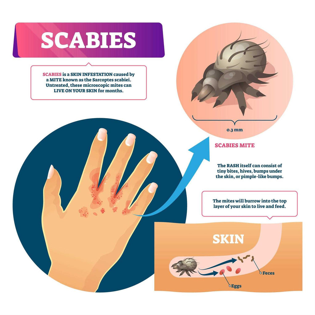 Scabies Cream J21601
